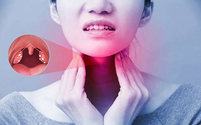 Viêm họng mạn tính là một bệnh thường gặp. Họng là nơi rất thuận lợi cho các yếu tố ngoại lai, virus và vi khuẩn xâm nhập vào cơ thể.